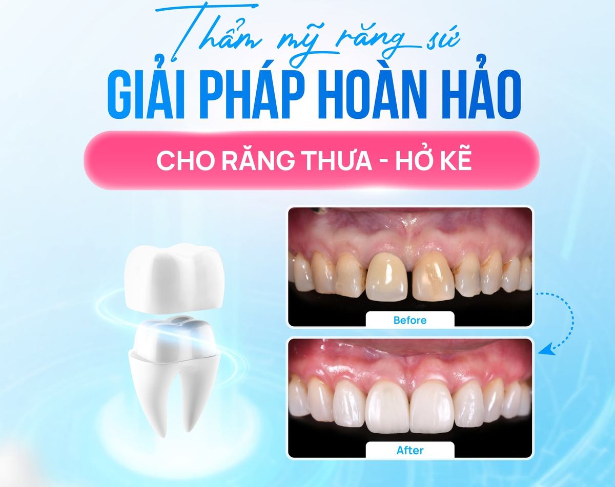 Bọc sứ phù hợp khi khoảng thưa khá lớn, khó tạo hình răng bằng phương pháp trám Hình: Bọc sứ phù hợp khi khoảng thưa khá lớn, khó tạo hình răng bằng phương pháp trám