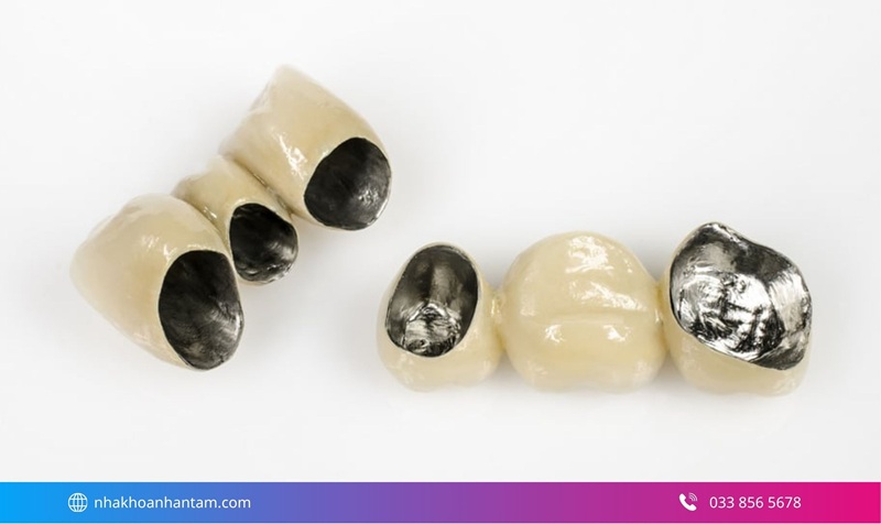 các loại răng sứ nên dùng