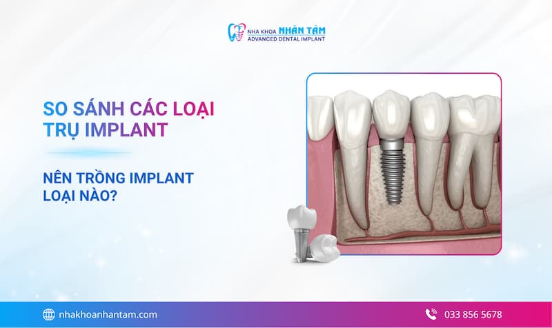 So sánh các loại Implant: Nên trồng răng Implant loại nào tốt nhất?