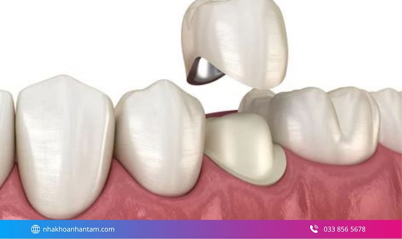 cách điều trị viêm tủy răng