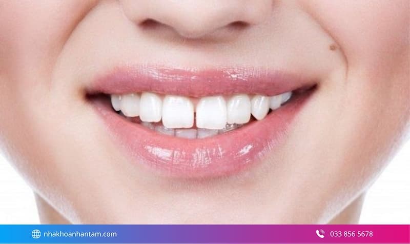 cảm giác khi trám răng