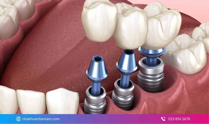 cảm giác khi trồng răng implant