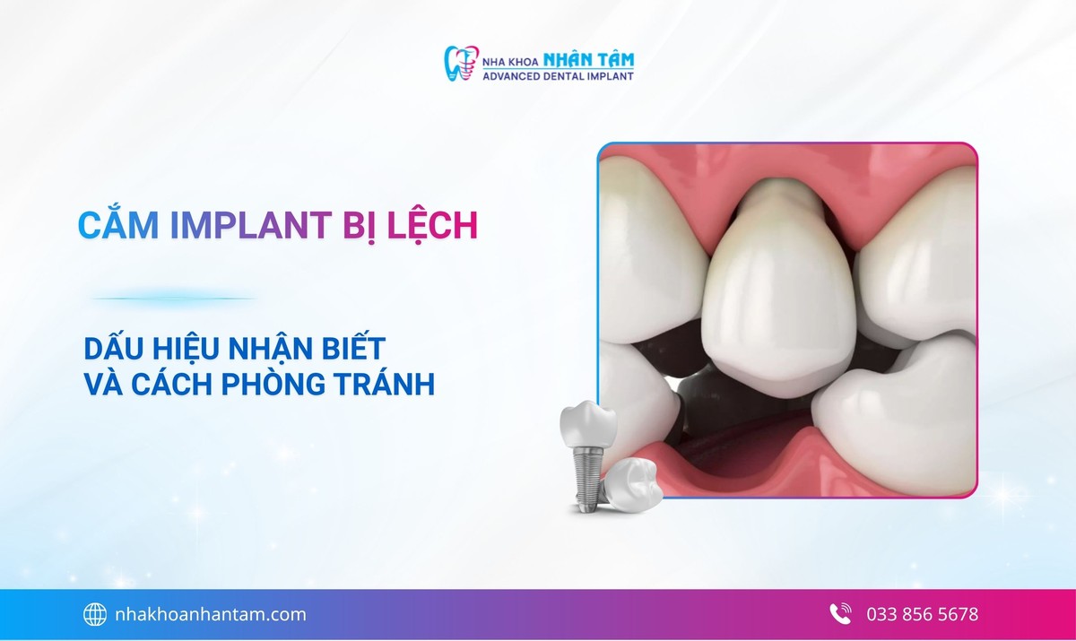 Cắm Implant bị lệch: Dấu hiệu, nguyên nhân và cách khắc phục