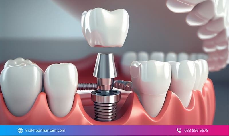 cảm nhận của người đã trồng implant