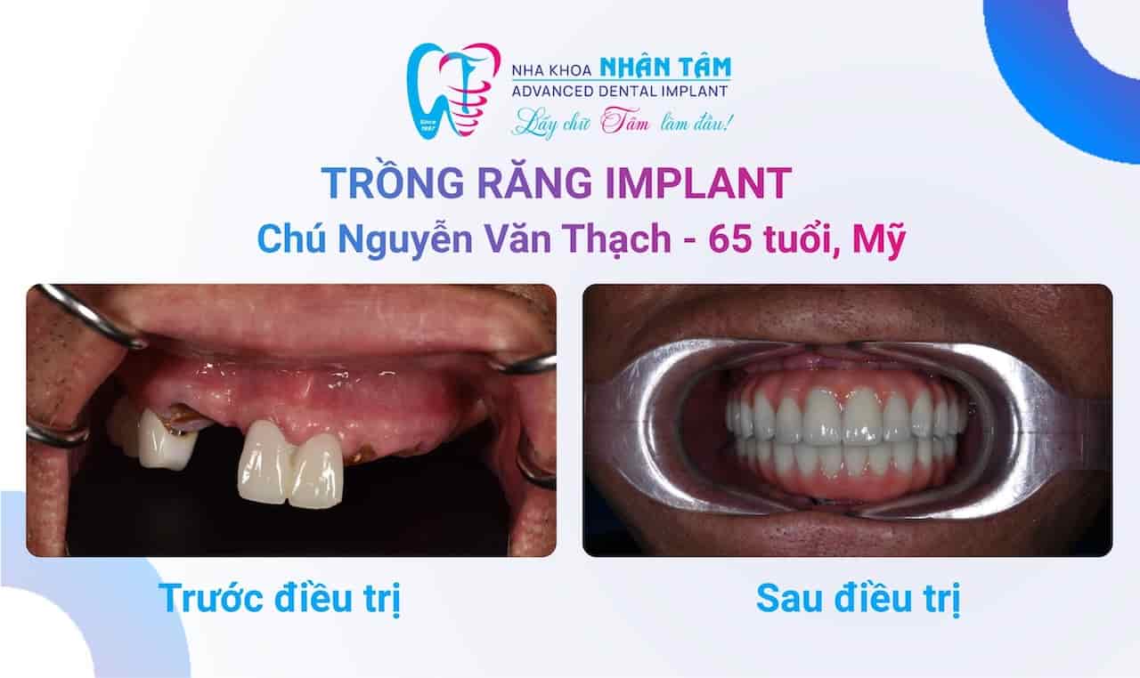Ăn nhai khó đã có trồng răng Implant lo