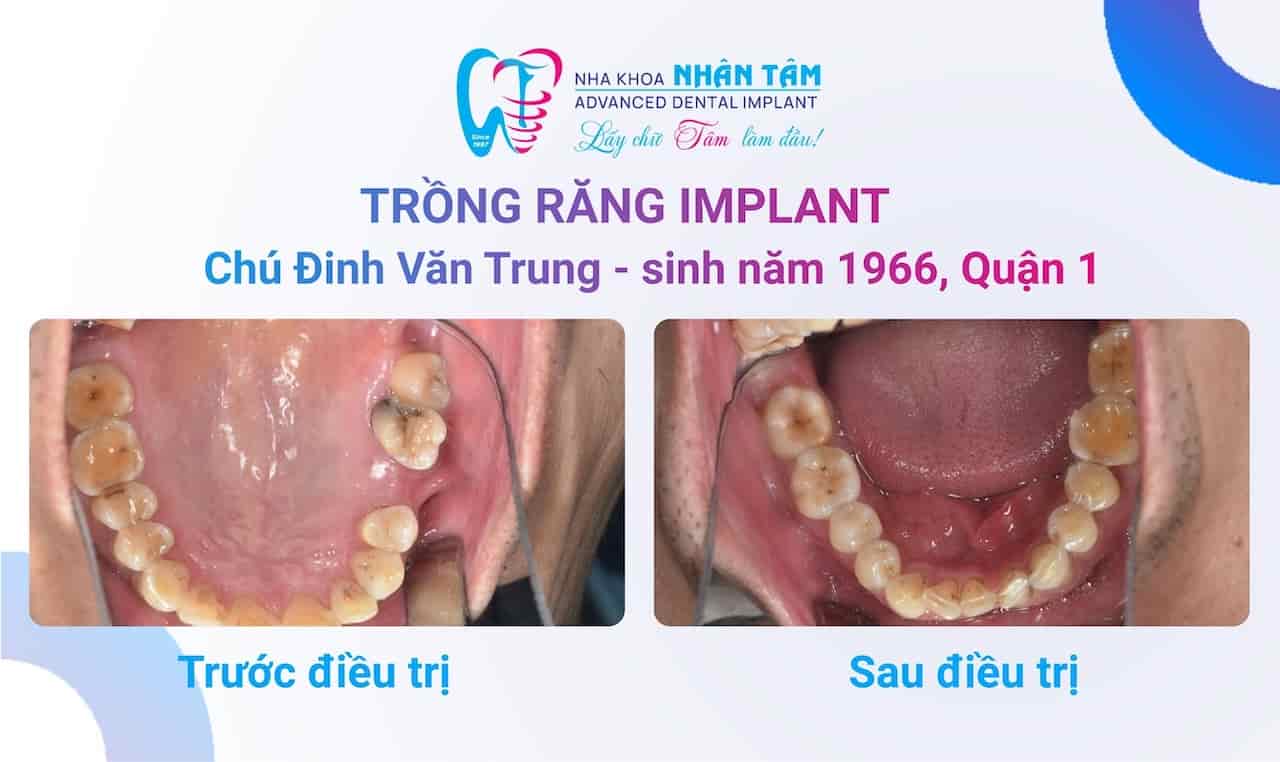 Cả gia đình cùng làm răng tại Nha khoa Nhân Tâm