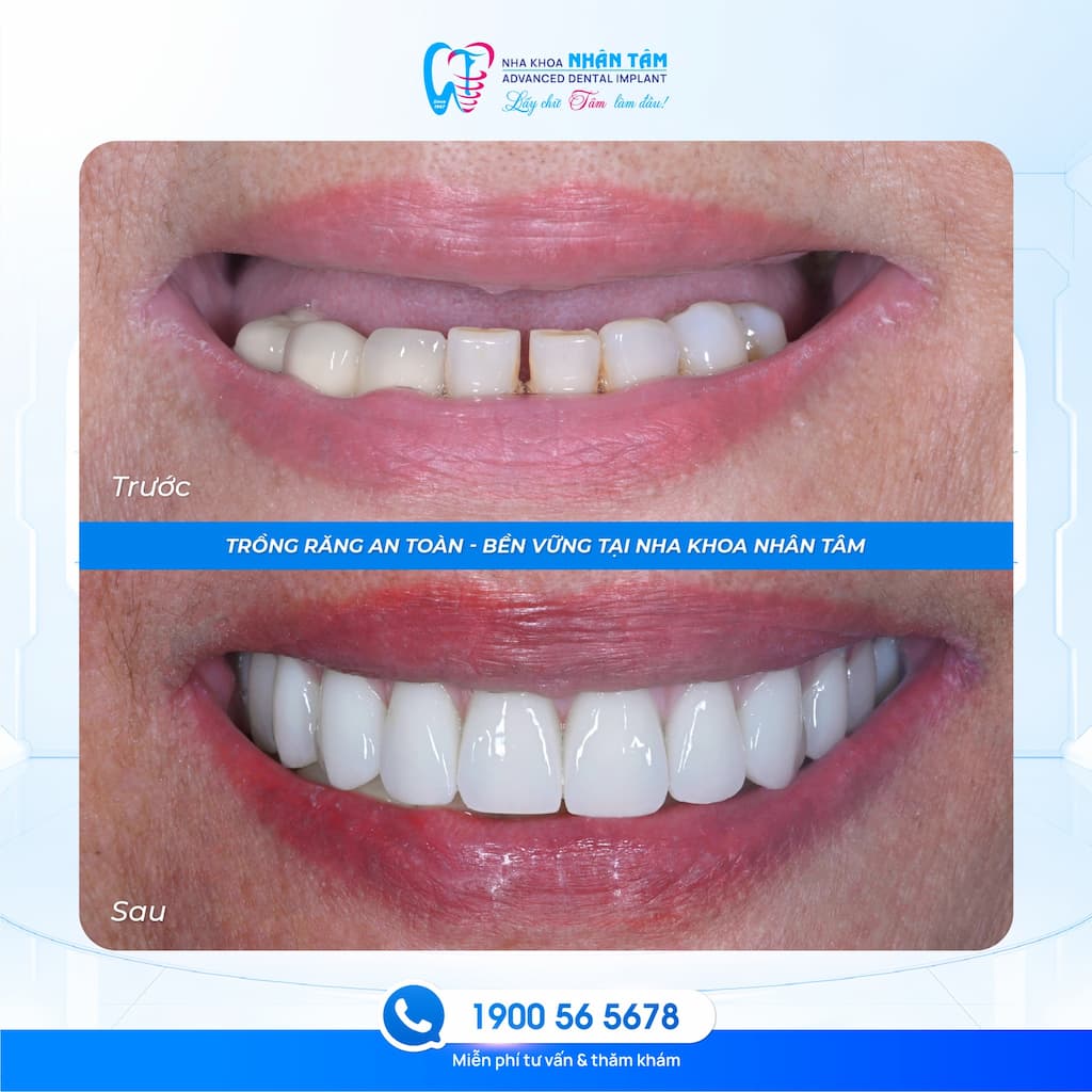 Cô Lâm Anh Đào hài lòng với khả năng ăn nhai sau 7 năm sử dụng Implant