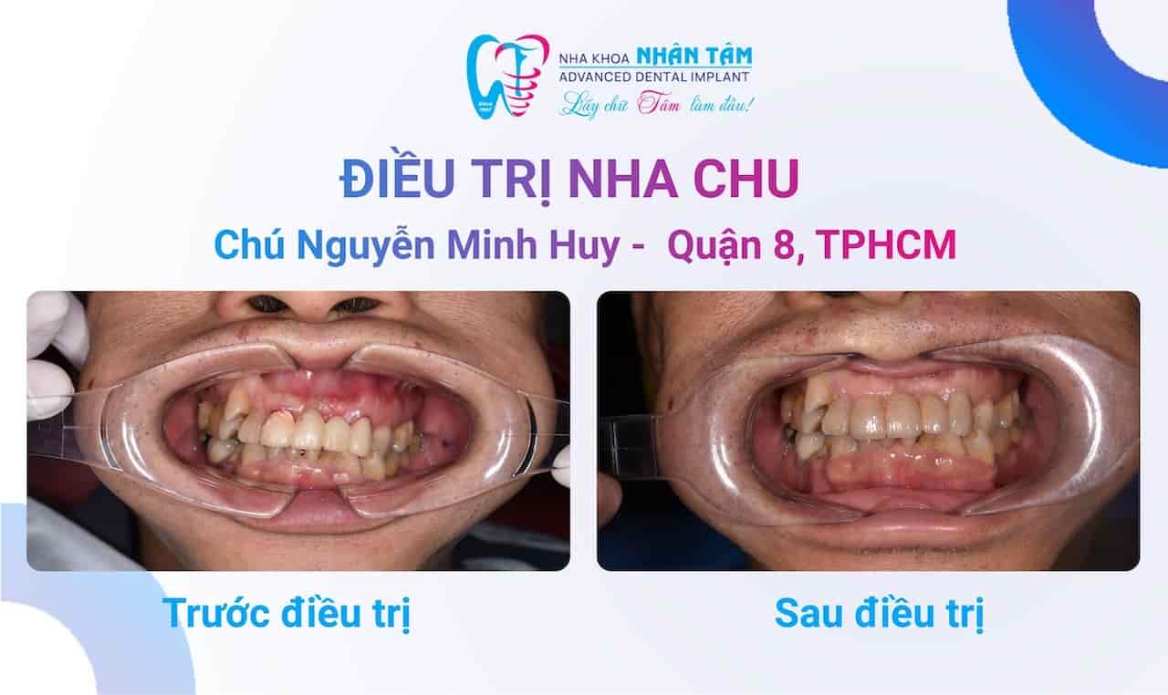 Giải pháp toàn diện cho sức khỏe răng miệng tại Nha khoa Nhân Tâm