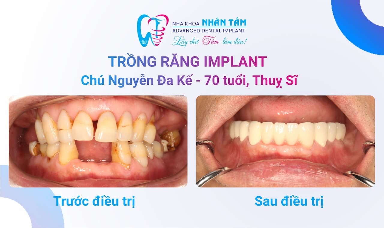 Khách hàng 70 tuổi cấy ghép Implant tại Nha khoa Nhân Tâm