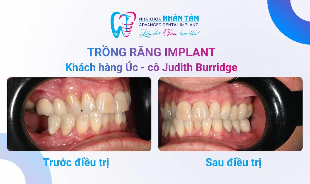 Hình: Khách hàng úc lần đầu trải nghiệm dịch vụ trồng răng implant tại nha khoa nhân tâm