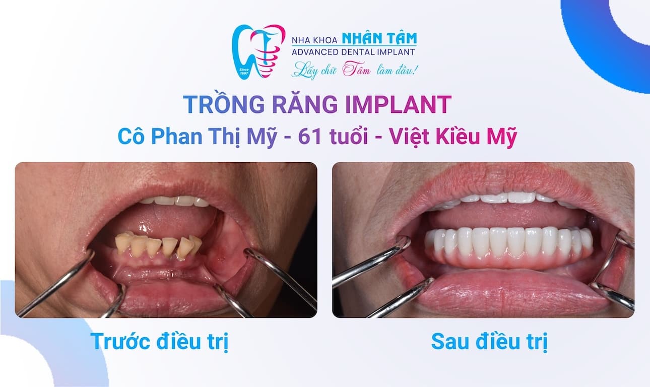 Lý do kiều bào Mỹ quay về Việt Nam trồng răng Implant