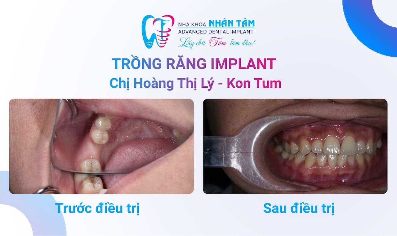 Răng implant bền bỉ sau 10 năm cấy ghép Hình: Răng implant bền bỉ sau 10 năm cấy ghép