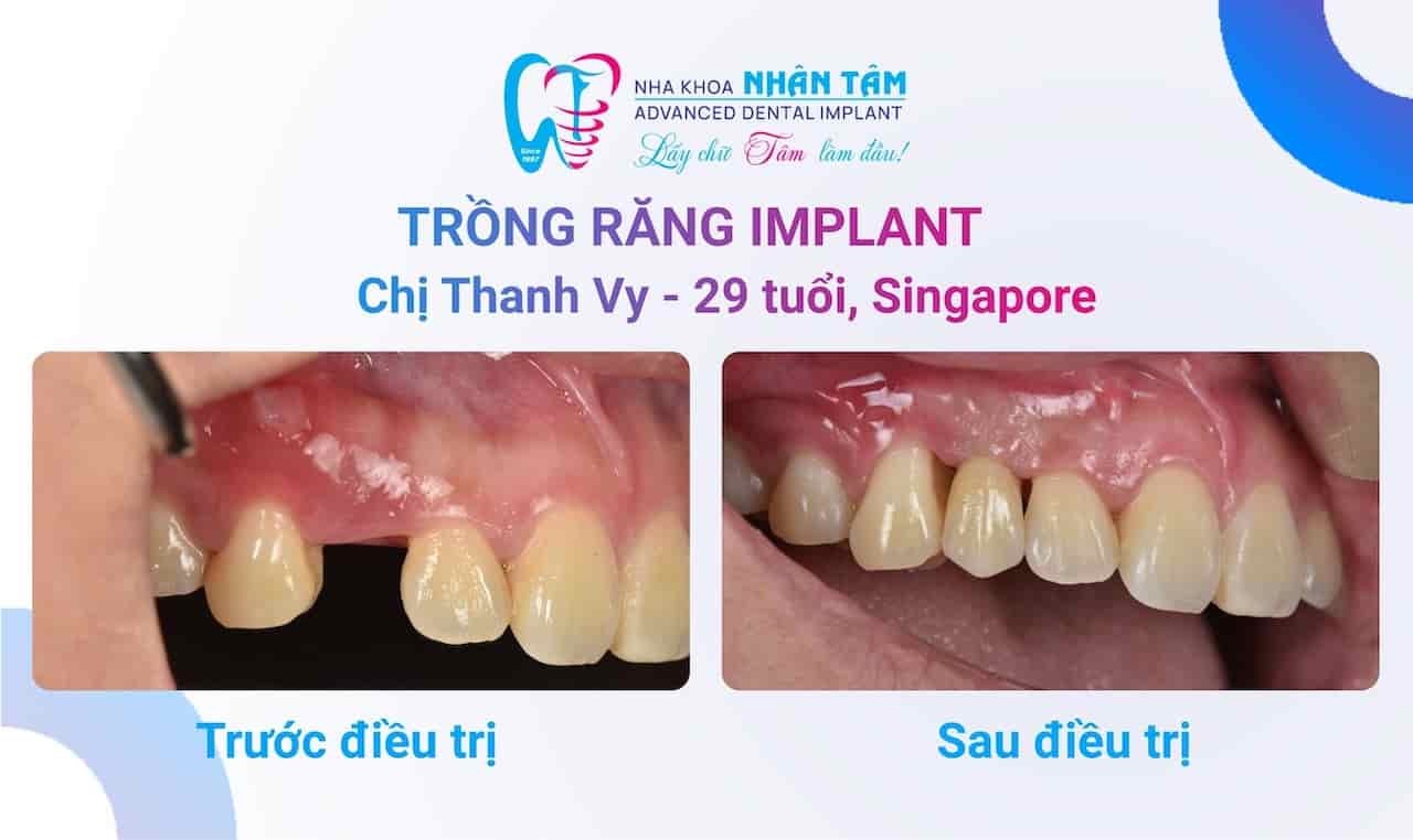 Đặt trọn niềm tin khi cấy ghép Implant tại Nha khoa Nhân Tâm