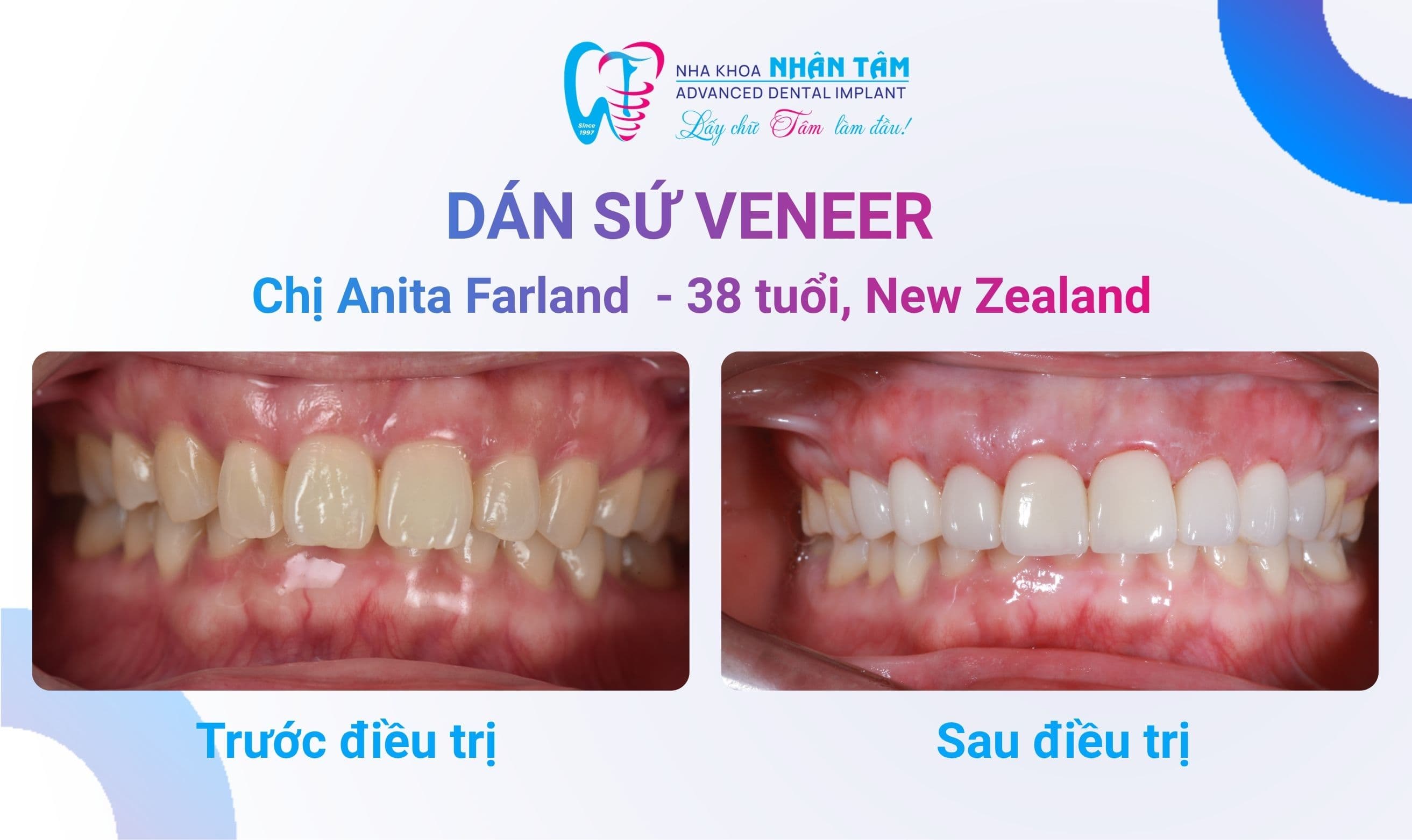 Đẹp tự nhiên với mặt dán sứ - Nha Khoa Nhân Tâm