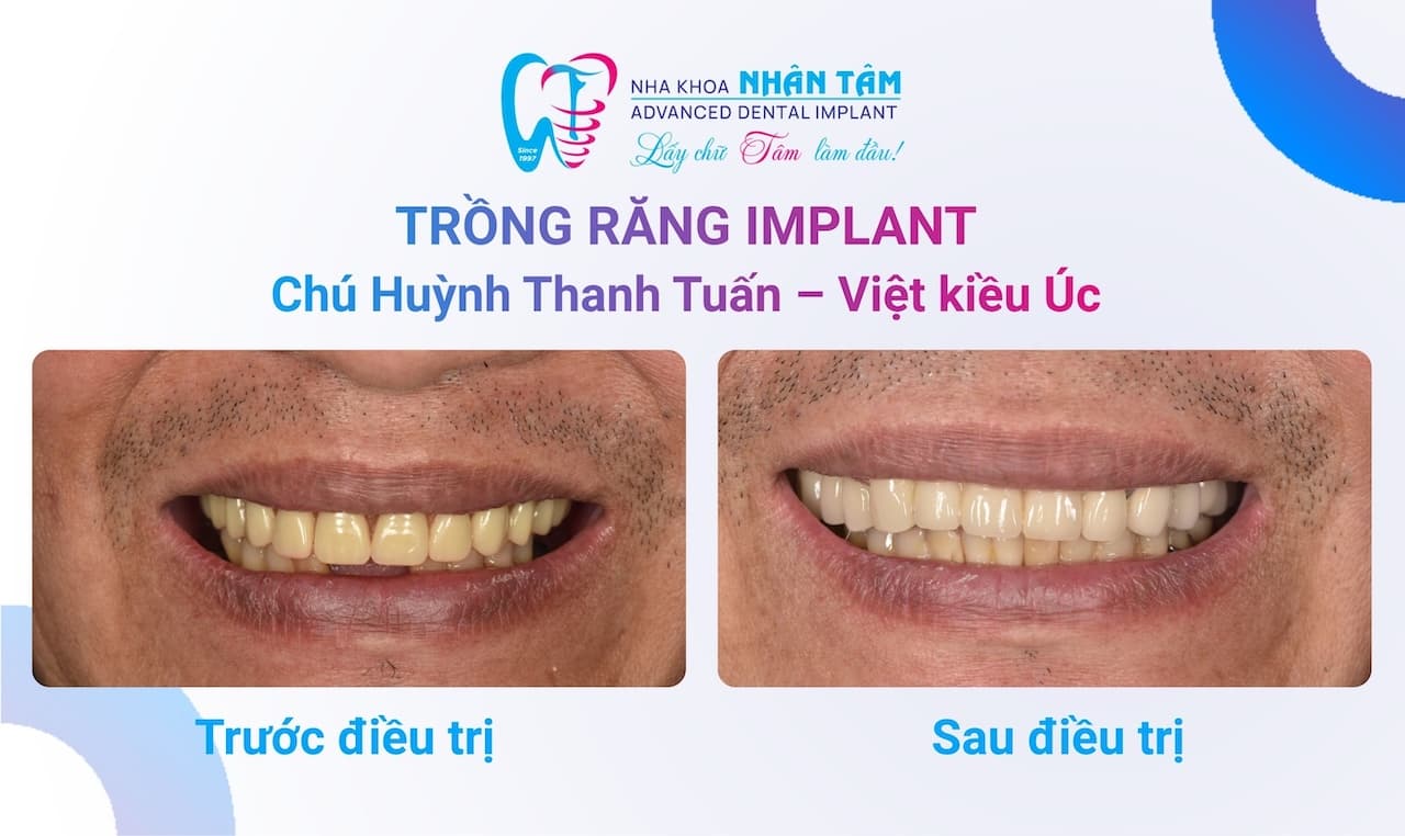 Tạm biệt hàm răng giả tháo lắp - Việt Kiều Úc tự tin ăn ngon, cười tươi nhờ trồng răng Implant