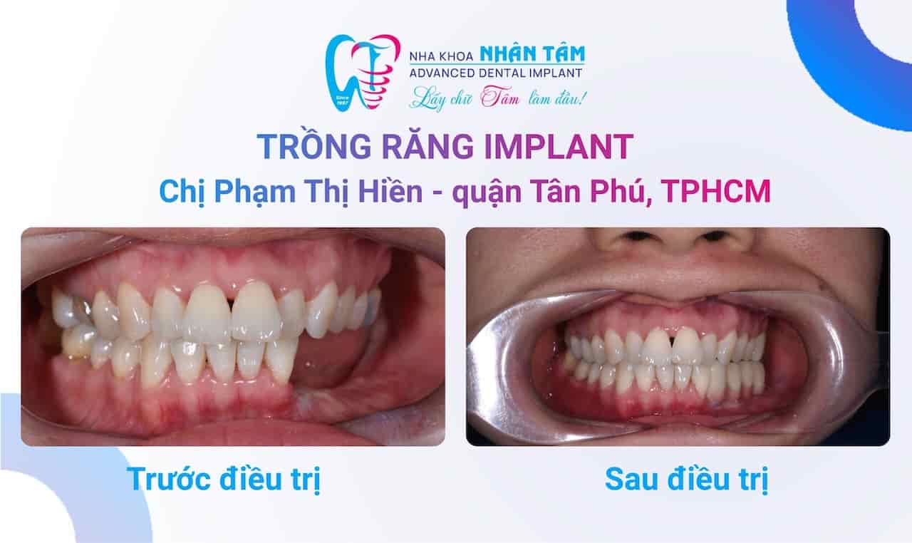 Tìm lại nụ cười rạng rỡ với phương pháp trồng răng Implant
