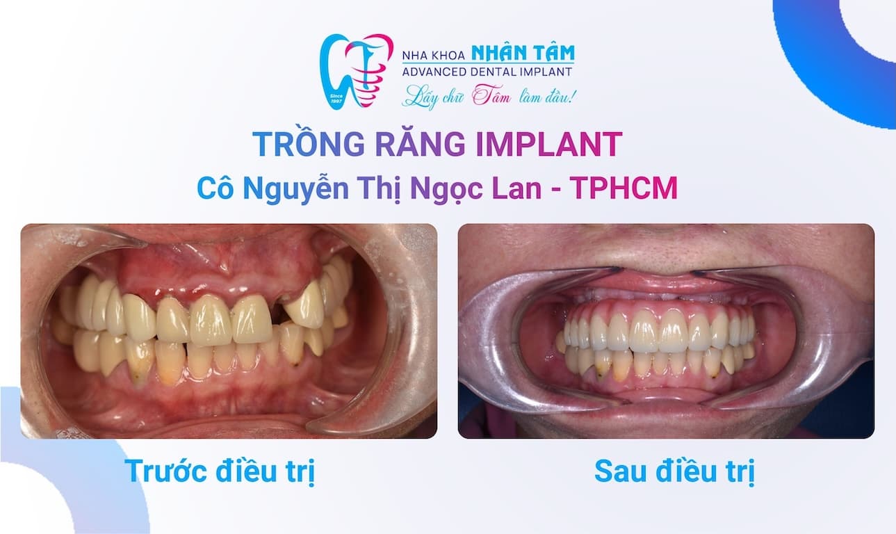 Trồng Răng Implant Như Đi Spa Tại Nha Khoa Nhân Tâm