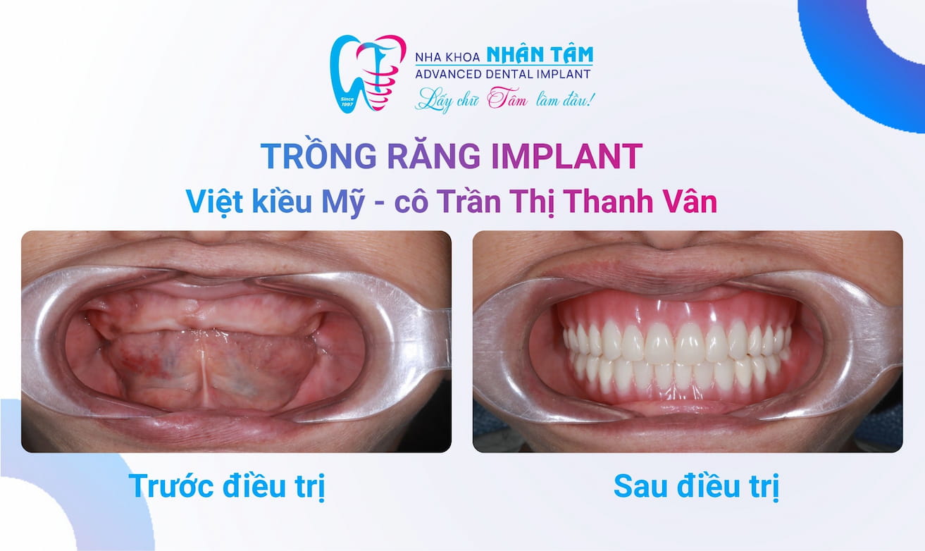 Cô Trần Thị Thanh Vân trước và sau điều trị tại Nha khoa Nhân Tâm