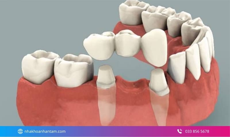 cầu răng và implant khác nhau gì