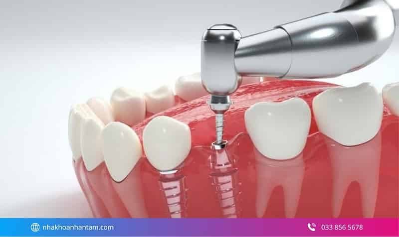cấy ghép implant có đau không sau khi làm