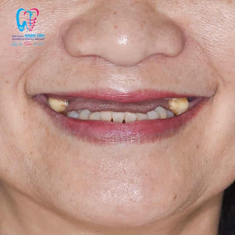 cấy ghép implant toàn hàm