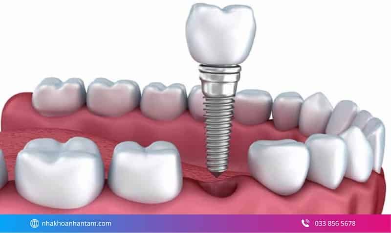 cấy ghép implant tức thì có đau không
