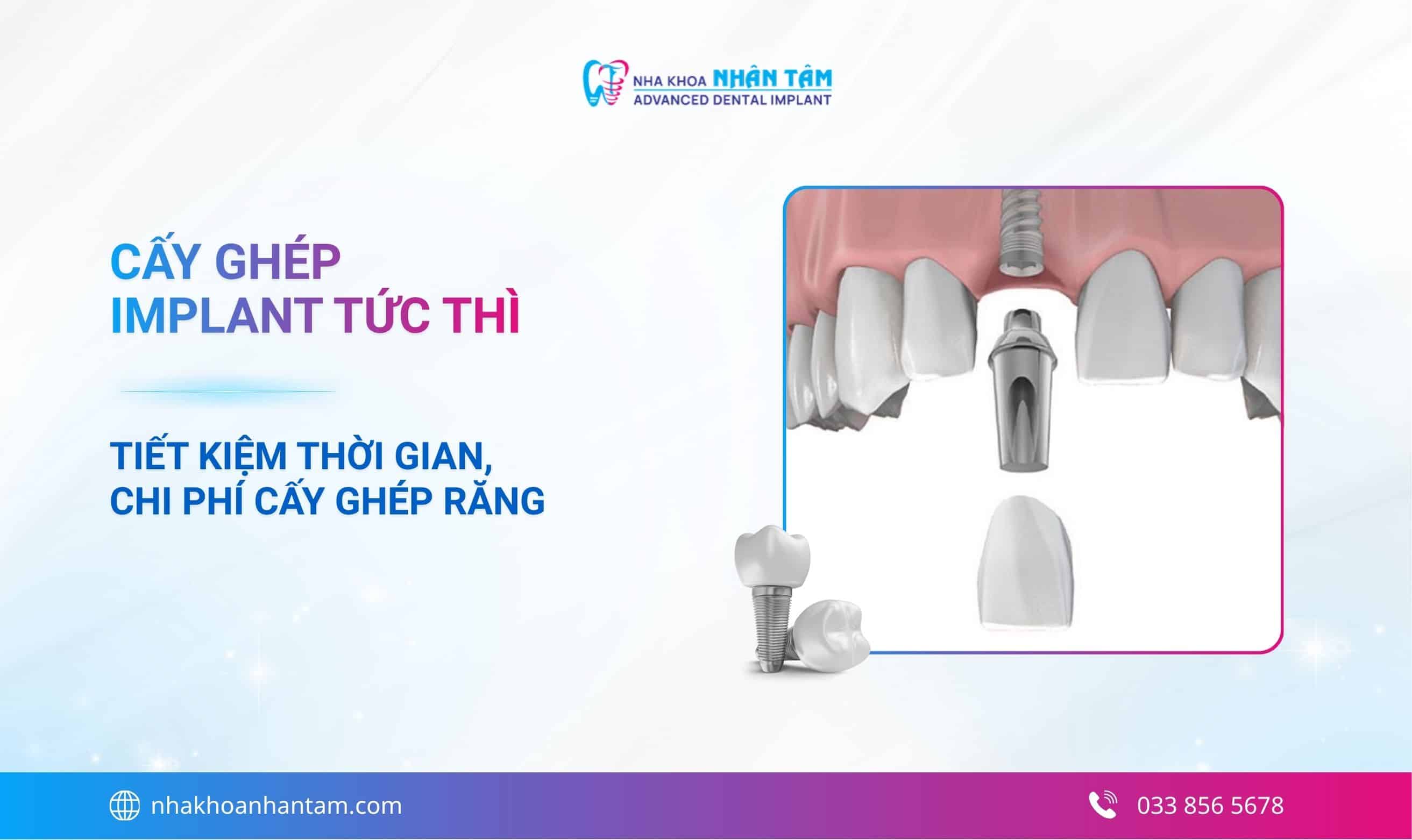 Cấy ghép Implant tức thì: Tiết kiệm thời gian, chi phí cấy ghép răng