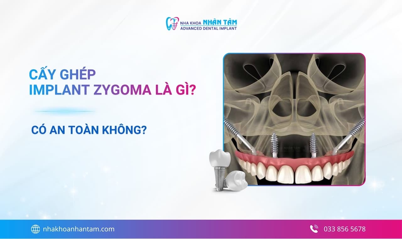 Cấy ghép Implant Zygoma là gì? Có an toàn không?