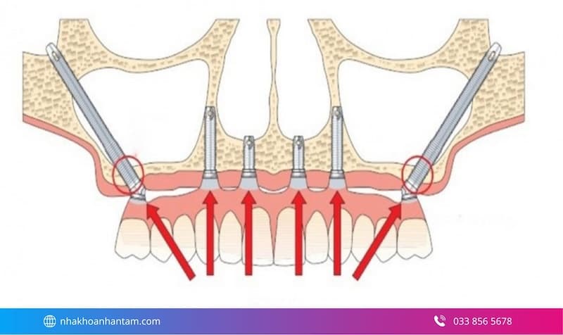 cấy implant xương gò má