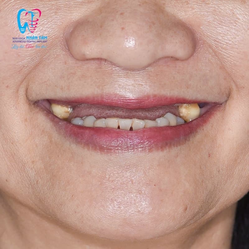 implant zygoma là gì