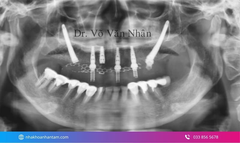 trụ implant zygoma
