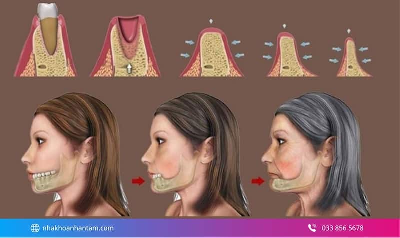 cấy ghép xương trước khi trồng implant