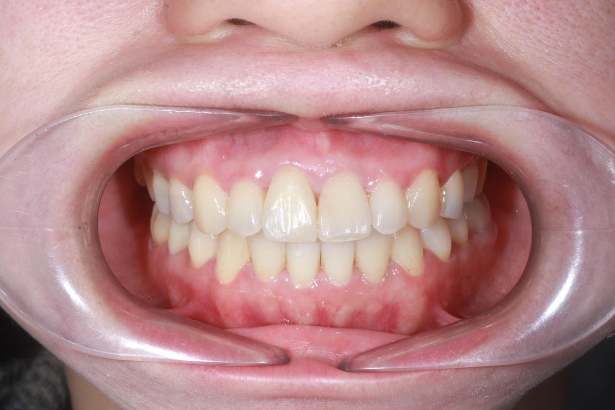 Chị Kiều Linh – quá trình điều trị Hình: Chị Kiều Linh – quá trình điều trị