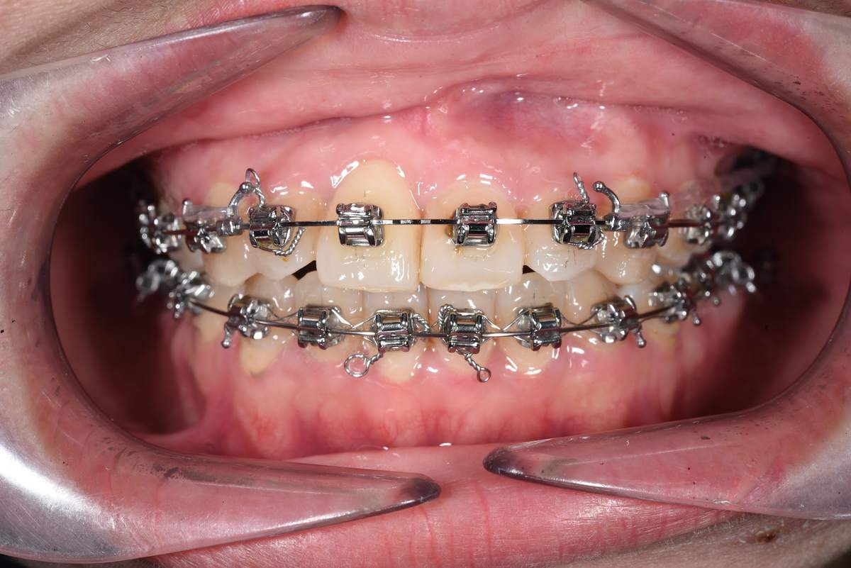 Chị Kiều Linh – tình trạng trước điều trị Hình: Chị Kiều Linh – tình trạng trước điều trị