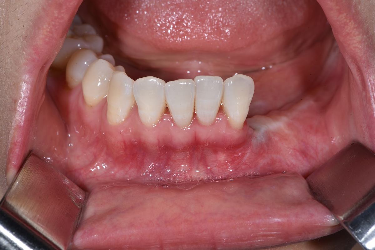 Hình: Chị Phạm Thị Hiền – tình trạng trước điều trị