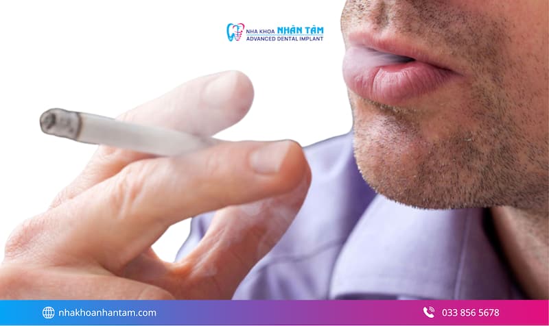 chi phí implant all on 4