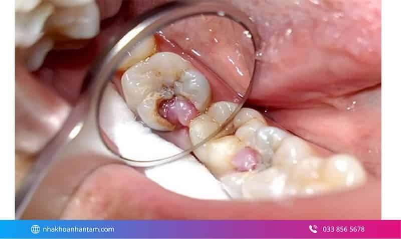 chi phí implant tức thì