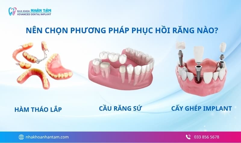 chi phí làm răng thay thế