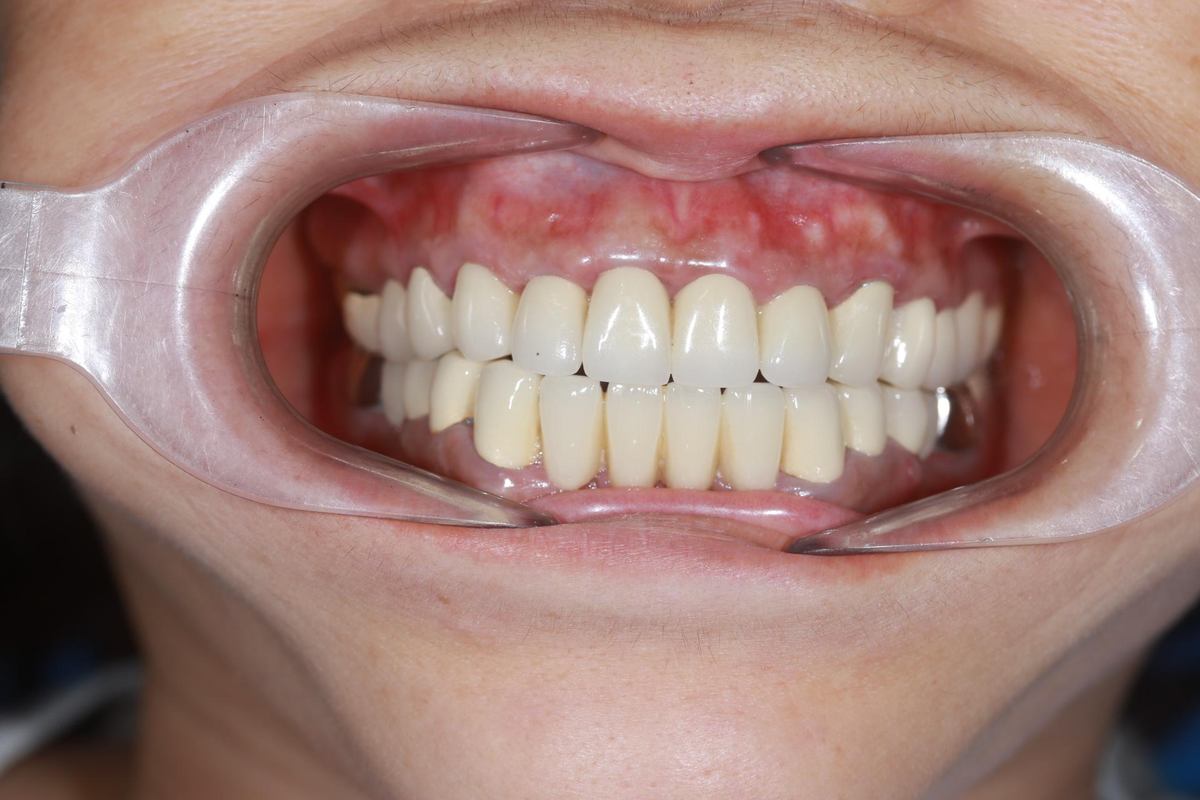 Hình: Chị Thái Mai Xuân – kết quả sau điều trị