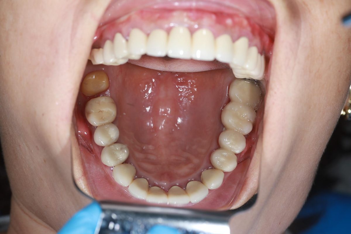Hình: Chị Thái Mai Xuân – quá trình điều trị