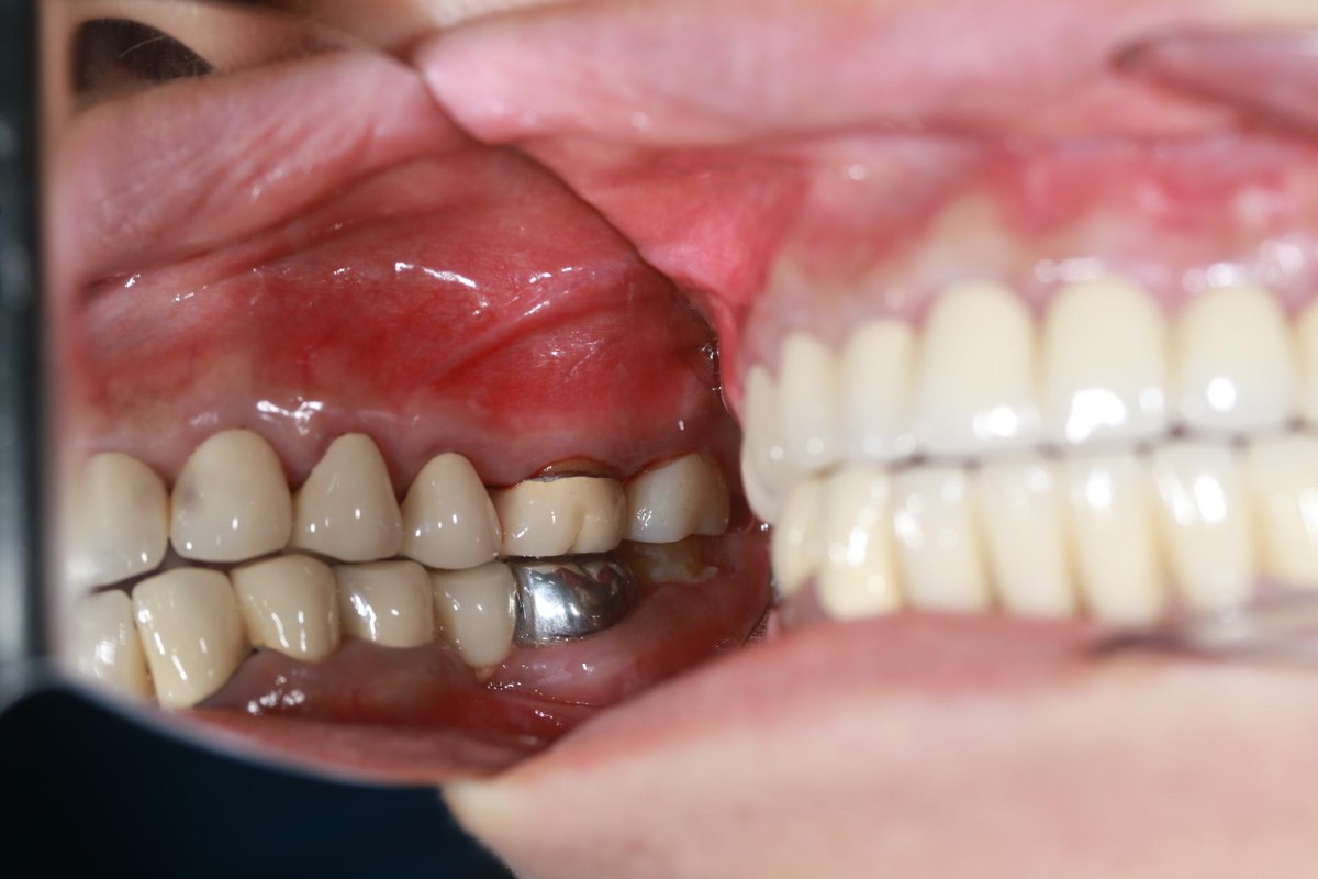 Hình: Chị Thái Mai Xuân – tình trạng trước điều trị