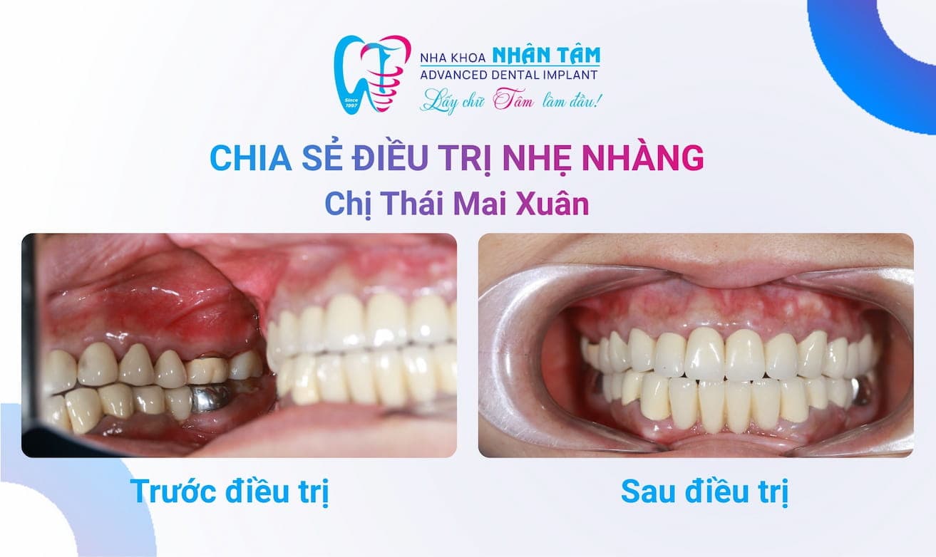 Chị Thái Mai Xuân chia sẻ trải nghiệm điều trị nhẹ nhàng tại Nha Khoa Nhân Tâm