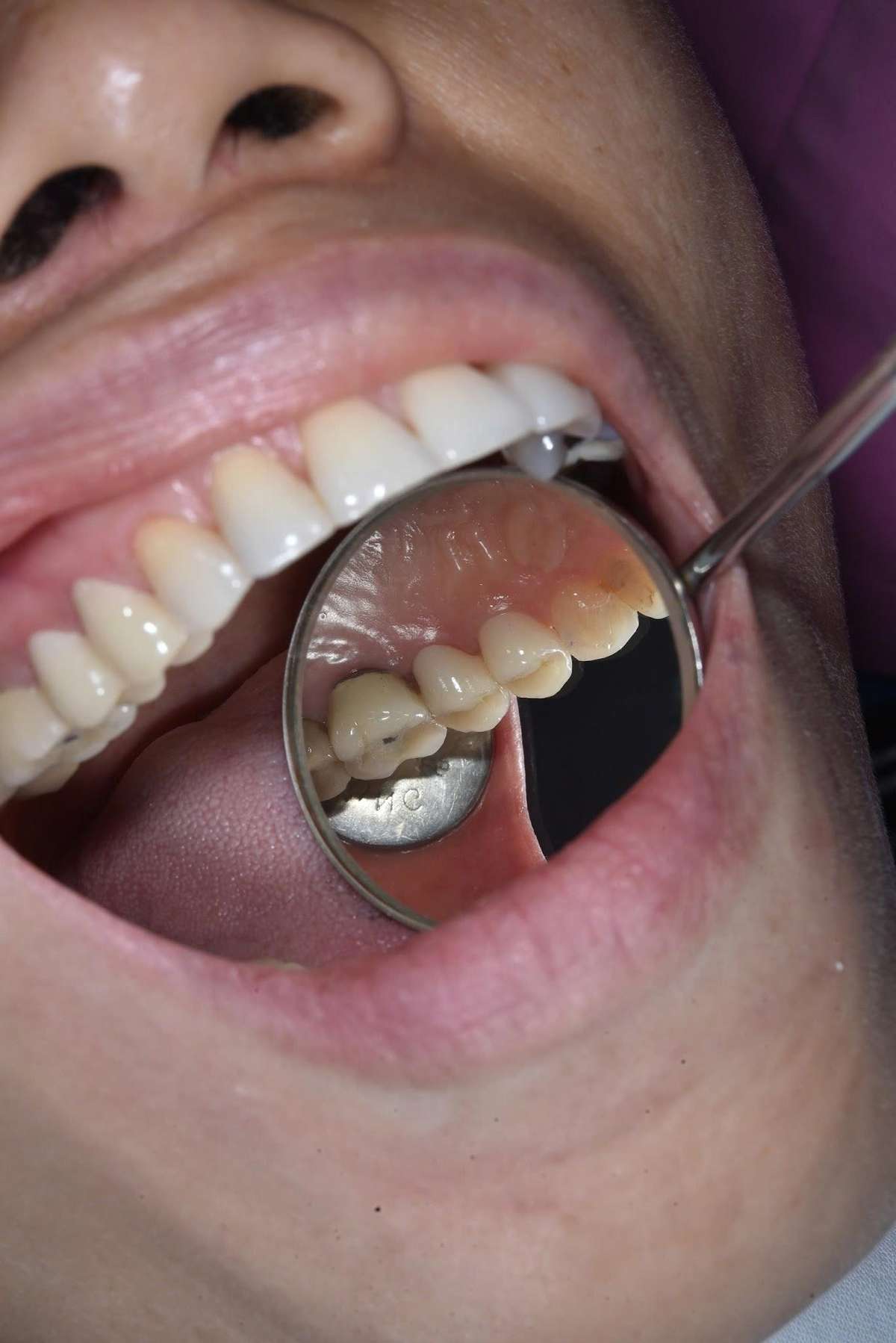 Chị Trương Xuân Hạnh – kết quả sau điều trị Hình: Chị Trương Xuân Hạnh – kết quả sau điều trị