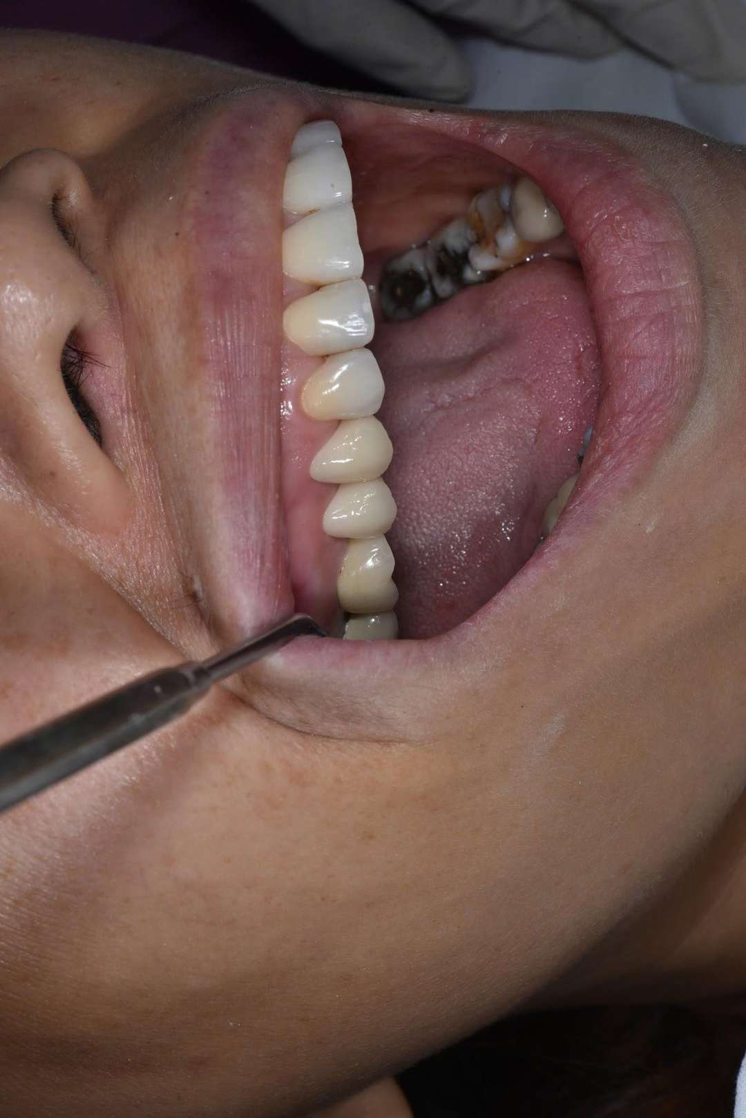 Chị Trương Xuân Hạnh – tình trạng trước điều trị Hình: Chị Trương Xuân Hạnh – tình trạng trước điều trị