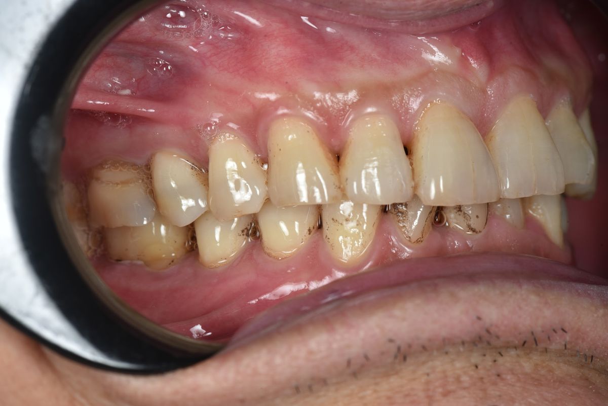 Chú Đinh Văn Trung – kết quả sau điều trị Hình: Chú Đinh Văn Trung – kết quả sau điều trị