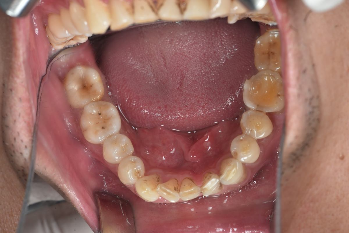 Chú Đinh Văn Trung – quá trình điều trị Hình: Chú Đinh Văn Trung – quá trình điều trị