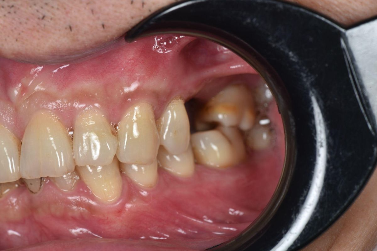 Chú Đinh Văn Trung – tình trạng trước điều trị Hình: Chú Đinh Văn Trung – tình trạng trước điều trị
