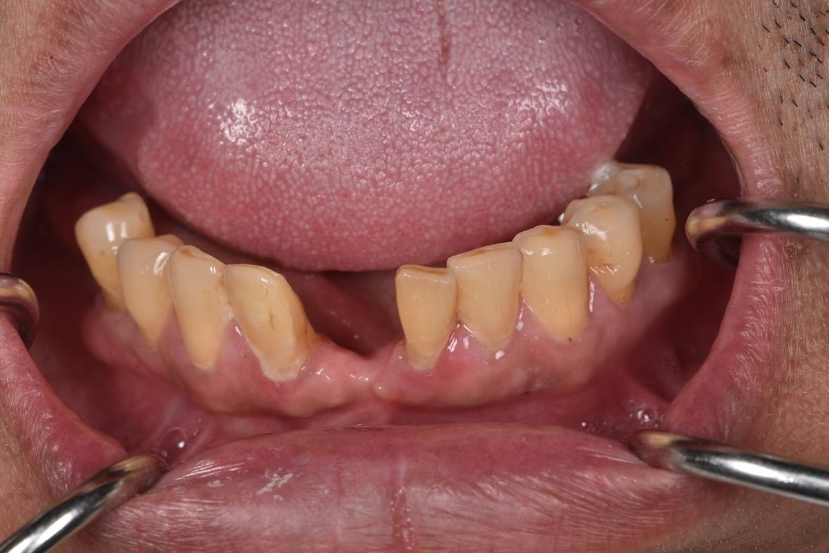 Hình: Chú Huỳnh Thanh Tuấn (Việt kiều Úc) – tình trạng trước điều trị