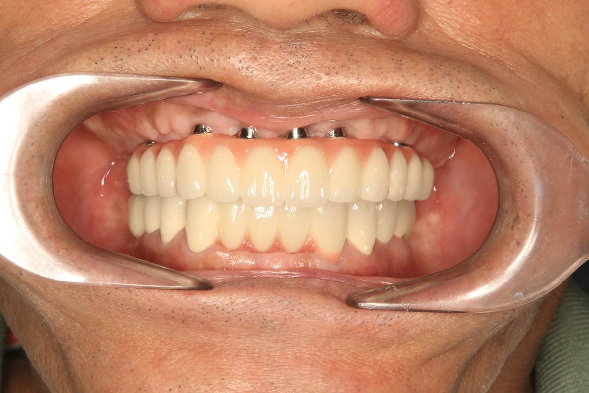 Hình: Chú Nguyễn Đa Kế (Việt kiều Thụy Sĩ) – quá trình điều trị