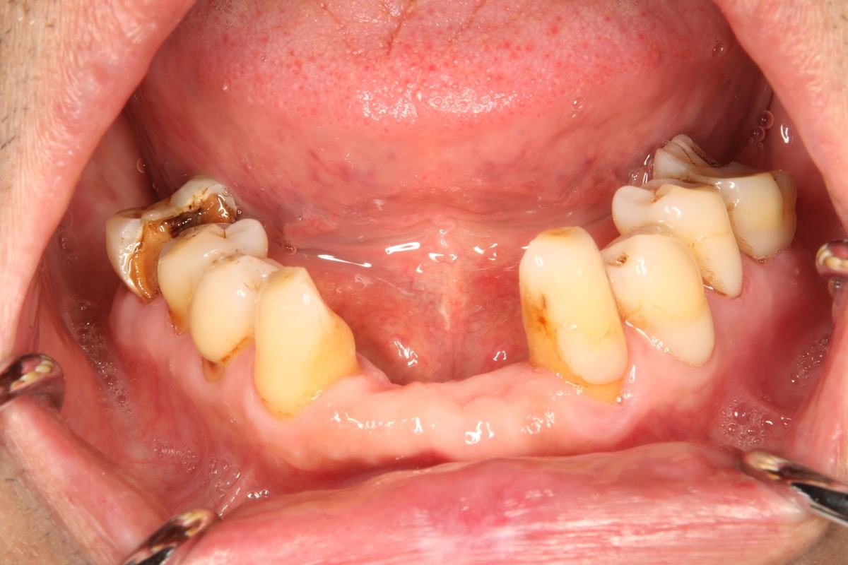 Hình: Chú Nguyễn Đa Kế (Việt kiều Thụy Sĩ) – tình trạng trước điều trị